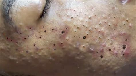 This video is meant to remove hidden acne, whiteheads and blackheads for girls. . Big deep blackheads 2021 loan nguyen